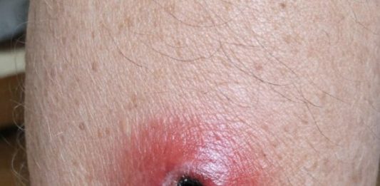 My husband woke up with this swollen red sore with a dark sunken center on his calf. We are hours from urgent care right now. Is this serious?