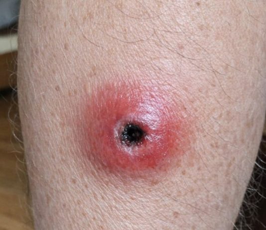 My husband woke up with this swollen red sore with a dark sunken center on his calf. We are hours from urgent care right now. Is this serious?