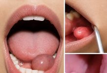 A Small Lump in the Mouth? Here Are the Early Symptoms You Shouldn’t Ignore