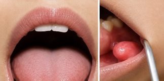 A Small Lump in the Mouth? Here Are the Early Symptoms You Shouldn’t Ignore