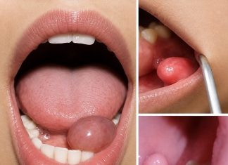 A Small Lump in the Mouth? Here Are the Early Symptoms You Shouldn’t Ignore