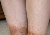 My grandmother keeps getting this rusty brown, scaly discoloration wrapping around her lower legs and ankles. The nurse line is busy. Is this serious?