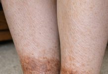 My grandmother keeps getting this rusty brown, scaly discoloration wrapping around her lower legs and ankles. The nurse line is busy. Is this serious?