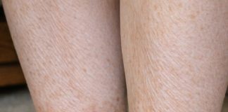 My grandmother keeps getting this rusty brown, scaly discoloration wrapping around her lower legs and ankles. The nurse line is busy. Is this serious?