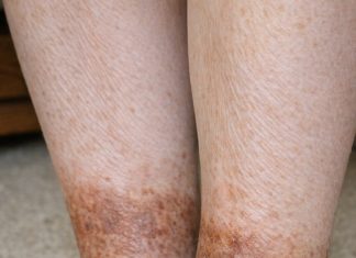My grandmother keeps getting this rusty brown, scaly discoloration wrapping around her lower legs and ankles. The nurse line is busy. Is this serious?