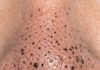 Rub this 1 mixture on your nose and get rid of deep dark blackheads, enlarged pores, and greasy buildup for glowing skin.