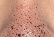 Rub this 1 mixture on your nose and get rid of deep dark blackheads, enlarged pores, and greasy buildup for glowing skin.