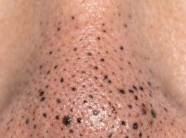 Rub this 1 mixture on your nose and get rid of deep dark blackheads, enlarged pores, and greasy buildup for glowing skin.