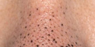 Rub this 1 mixture on your nose and get rid of deep dark blackheads, enlarged pores, and greasy buildup for glowing skin.