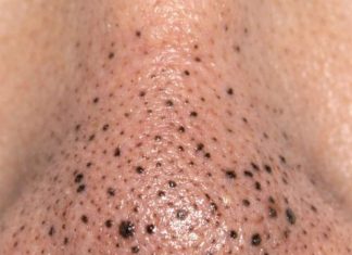 Rub this 1 mixture on your nose and get rid of deep dark blackheads, enlarged pores, and greasy buildup for glowing skin.
