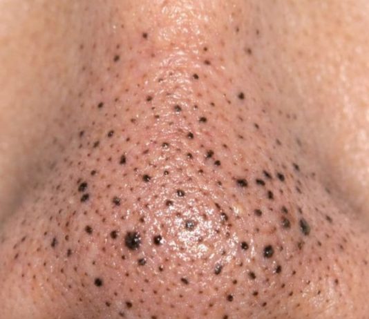 Rub this 1 mixture on your nose and get rid of deep dark blackheads, enlarged pores, and greasy buildup for glowing skin.