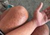 Skin Rash With Breathing Trouble? It Could Be a Life-Threatening Allergic Reaction