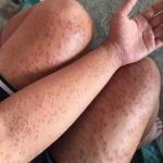 Skin Rash With Breathing Trouble? It Could Be a Life-Threatening Allergic Reaction