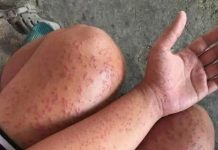 Skin Rash With Breathing Trouble? It Could Be a Life-Threatening Allergic Reaction