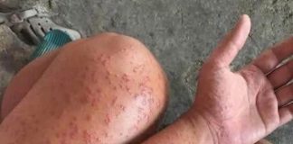 Skin Rash With Breathing Trouble? It Could Be a Life-Threatening Allergic Reaction