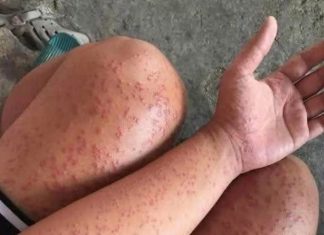 Skin Rash With Breathing Trouble? It Could Be a Life-Threatening Allergic Reaction