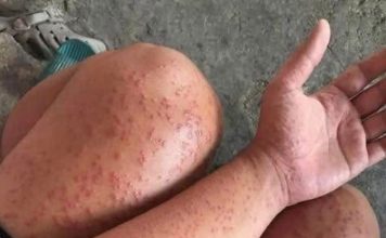 Skin Rash With Breathing Trouble? It Could Be a Life-Threatening Allergic Reaction