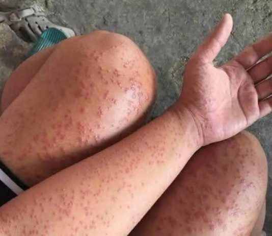 Skin Rash With Breathing Trouble? It Could Be a Life-Threatening Allergic Reaction