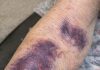Mom keeps getting these huge dark purple patches on her forearms from the smallest bump. The clinic is closed for the weekend. Is this serious?
