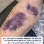 Mom keeps getting these huge dark purple patches on her forearms from the smallest bump. The clinic is closed for the weekend. Is this serious?