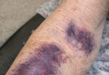Mom keeps getting these huge dark purple patches on her forearms from the smallest bump. The clinic is closed for the weekend. Is this serious?
