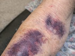 Mom keeps getting these huge dark purple patches on her forearms from the smallest bump. The clinic is closed for the weekend. Is this serious?