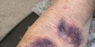 Mom keeps getting these huge dark purple patches on her forearms from the smallest bump. The clinic is closed for the weekend. Is this serious?