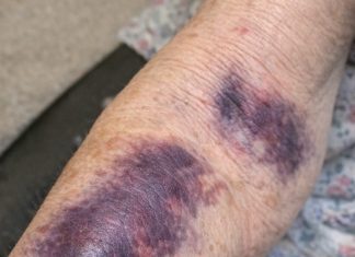 Mom keeps getting these huge dark purple patches on her forearms from the smallest bump. The clinic is closed for the weekend. Is this serious?