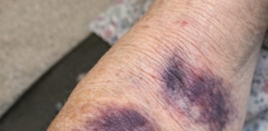 Mom keeps getting these huge dark purple patches on her forearms from the smallest bump. The clinic is closed for the weekend. Is this serious?