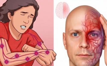 A month before a stroke, your body warns you: 10 signs not to ignore