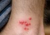 My toddler woke up with these tiny red bumps clustered all around his ankles. The nurse line is completely busy and he keeps scratching them. What is this?