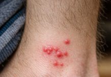 My toddler woke up with these tiny red bumps clustered all around his ankles. The nurse line is completely busy and he keeps scratching them. What is this?