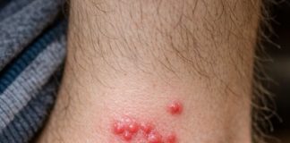 My toddler woke up with these tiny red bumps clustered all around his ankles. The nurse line is completely busy and he keeps scratching them. What is this?