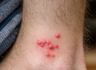 My toddler woke up with these tiny red bumps clustered all around his ankles. The nurse line is completely busy and he keeps scratching them. What is this?