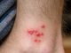 My toddler woke up with these tiny red bumps clustered all around his ankles. The nurse line is completely busy and he keeps scratching them. What is this?
