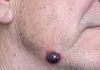 My husband has this dark purple squishy bump on his jawline that looks just like a blood blister. The nurse line keeps putting us on hold. Is this serious?