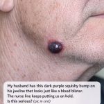 My husband has this dark purple squishy bump on his jawline that looks just like a blood blister. The nurse line keeps putting us on hold. Is this serious?