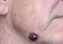 My husband has this dark purple squishy bump on his jawline that looks just like a blood blister. The nurse line keeps putting us on hold. Is this serious?