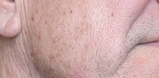 My husband has this dark purple squishy bump on his jawline that looks just like a blood blister. The nurse line keeps putting us on hold. Is this serious?