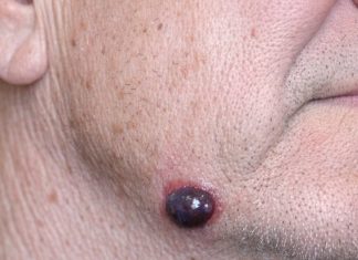 My husband has this dark purple squishy bump on his jawline that looks just like a blood blister. The nurse line keeps putting us on hold. Is this serious?