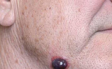 My husband has this dark purple squishy bump on his jawline that looks just like a blood blister. The nurse line keeps putting us on hold. Is this serious?
