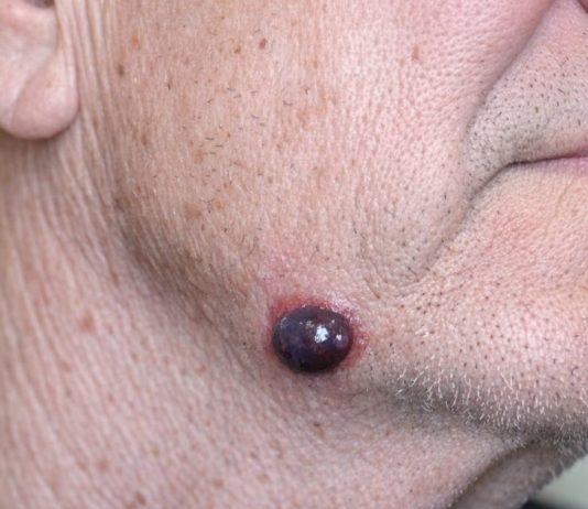 My husband has this dark purple squishy bump on his jawline that looks just like a blood blister. The nurse line keeps putting us on hold. Is this serious?