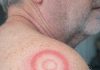 My husband woke up with this strange red ring with a clear center on his shoulder. It looks like a target. We are hours from urgent care right now. What is this?