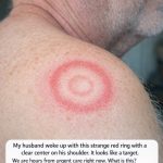 My husband woke up with this strange red ring with a clear center on his shoulder. It looks like a target. We are hours from urgent care right now. What is this?