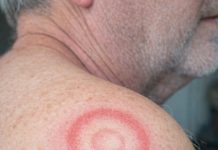 My husband woke up with this strange red ring with a clear center on his shoulder. It looks like a target. We are hours from urgent care right now. What is this?