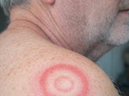 My husband woke up with this strange red ring with a clear center on his shoulder. It looks like a target. We are hours from urgent care right now. What is this?