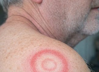 My husband woke up with this strange red ring with a clear center on his shoulder. It looks like a target. We are hours from urgent care right now. What is this?