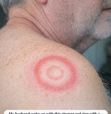 My husband woke up with this strange red ring with a clear center on his shoulder. It looks like a target. We are hours from urgent care right now. What is this?
