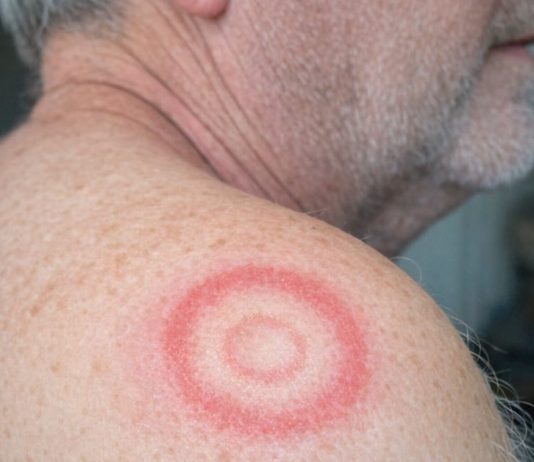 My husband woke up with this strange red ring with a clear center on his shoulder. It looks like a target. We are hours from urgent care right now. What is this?