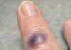 Mom Woke Up With This Sudden Dark Purple Bruise Bulging Under Her Finger. She Says It Stings, but the Clinic Is Closed Today. Is This Serious?